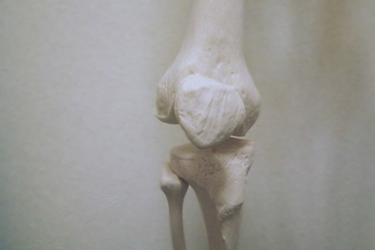 変形性膝関節症の原因イメージ