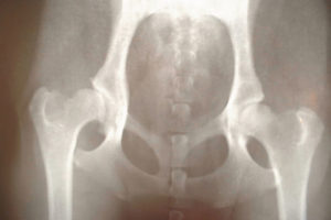 股関節痛の原因イメージ
