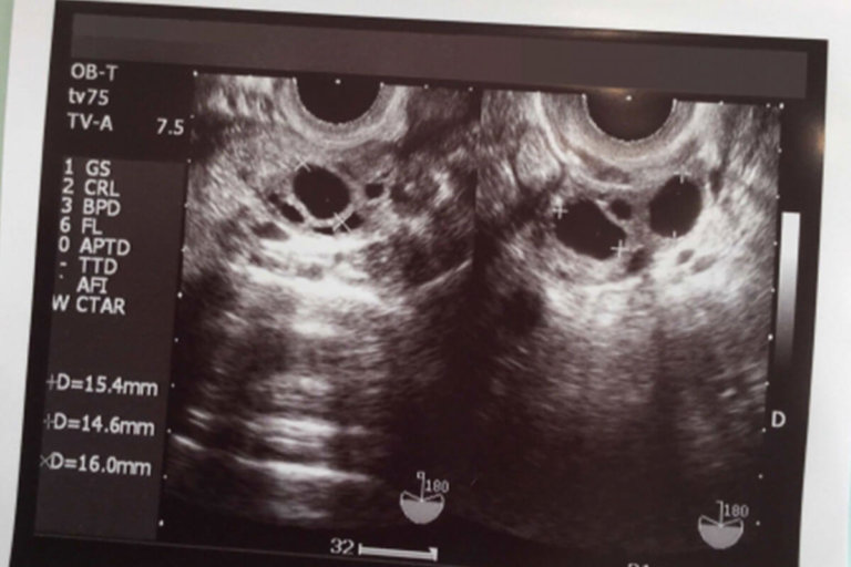 卵巣嚢腫と卵巣がんの症状